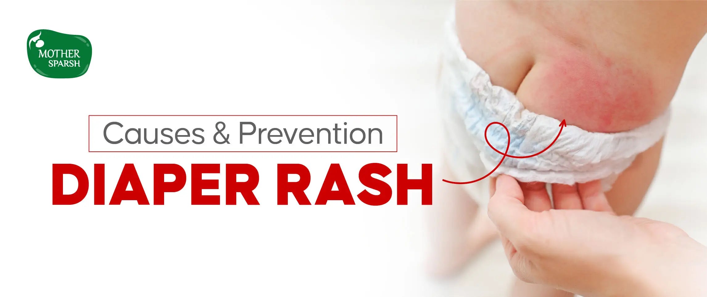 Diaper Rash In Children Diaper Rash in Babies: Causes, Prevention & Care Tips