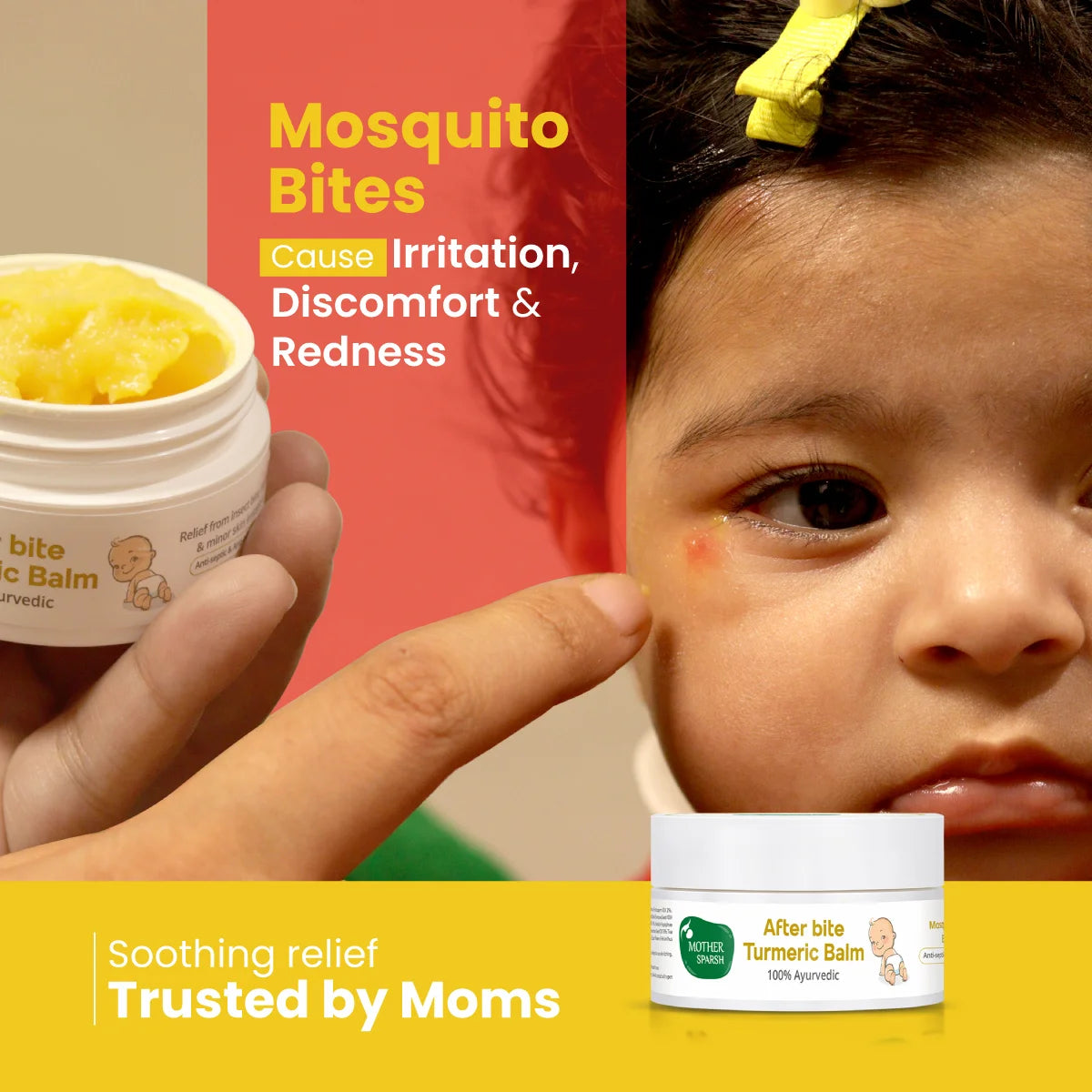 Mosquito bites causing irritation, discomfort, and redness, relieved with natural after-bite solutions.